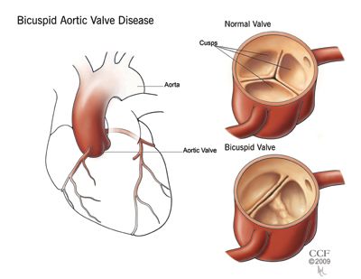 bicuspid_aortic_valve_disease